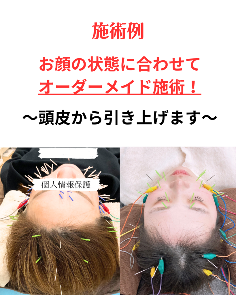 施術例お顔の状態に合わせてオーダーメイド施術!頭皮から引き上げます。