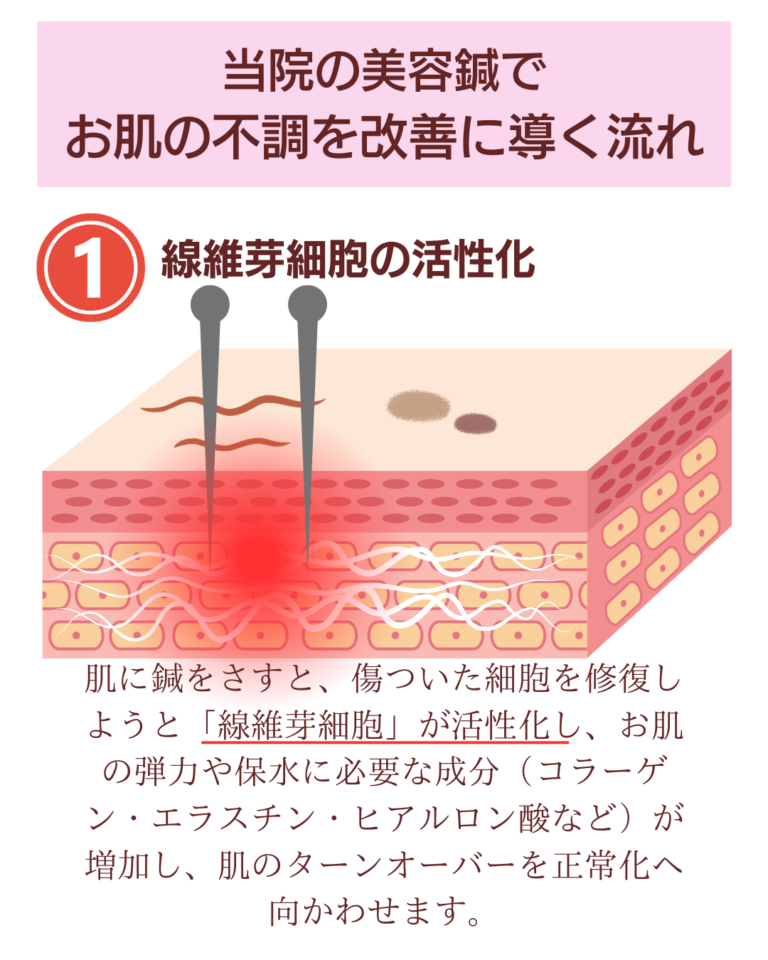 当院の美容鍼、改善に導く流れ
線維芽細胞の活性化
肌に鍼を刺すと、傷ついた細胞を修復しようと鮮宇が細胞が活性化